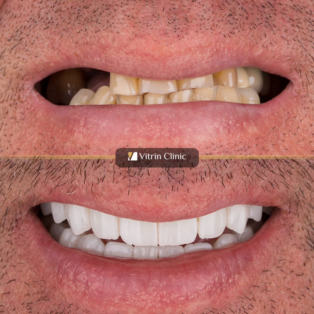 Dental Implant Failure in Patients With Diabetes: Causes, Risks, and Treatment Options